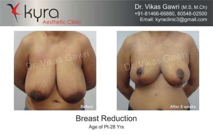 Breast Reduction