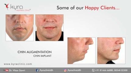 Chin Augmentation Chin Implant Our Happy Clients