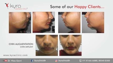 Chin Augmentation Chin Implant