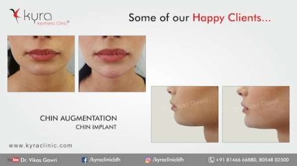 Chin Implant in Ludhiana