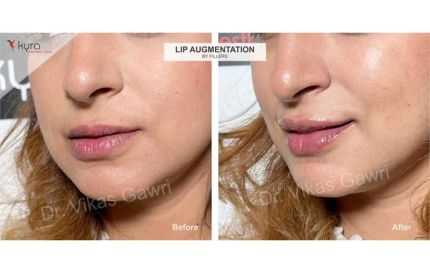 Expert Lip Augmentation Surgery in Ludhiana