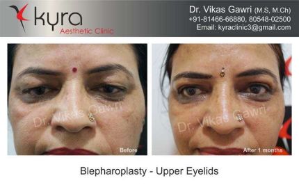 Eyelid Surgery in Ludhiana