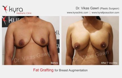 Fat Grafting For Breast Augmentation