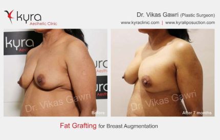 Fat Grafting For Breast Augmentation