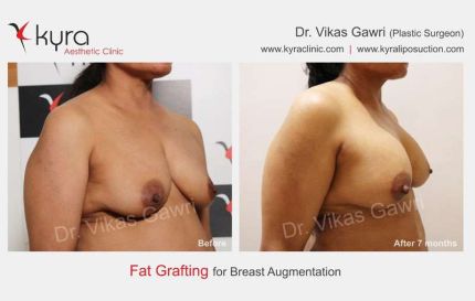 Fat Grafting For Breast Augmentation