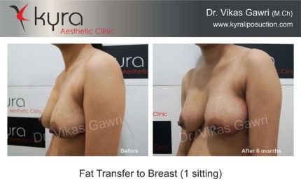 Fat Transfer to Breast setting