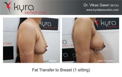 Fat Transfer to Breast setting