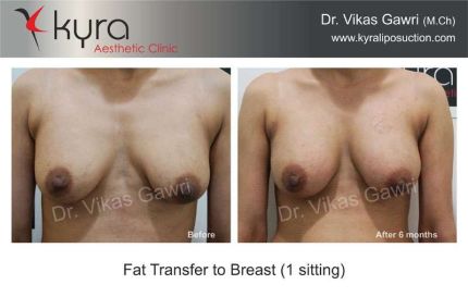 Fat Transfer to Breast setting