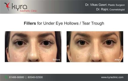 Fillers for Under Eye Hollows Tear Trough