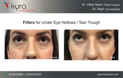 Fillers for Under Eye Hollows Tear Trough