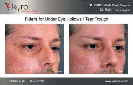 Fillers for Under Eye Hollows Tear Trough