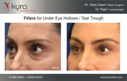 Fillers for Under Eye Hollows Tear Trough