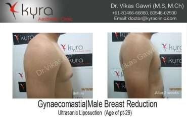 Gynaecomastia Male Breast Reduction