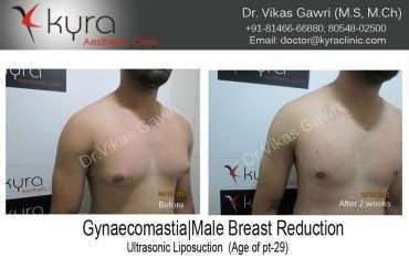 Gynaecomastia Male Breast Reduction