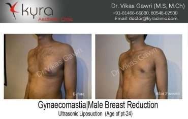 Gynaecomastia Male Breast Reduction