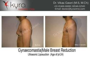 Gynaecomastia Male Breast Reduction