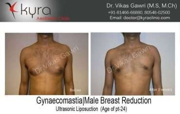 Gynaecomastia Male Breast Reduction