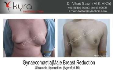 Gynaecomastia Male Breast Reduction