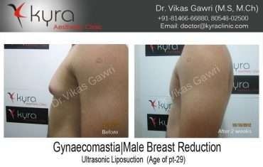 Gynaecomastia Male Breast Reduction