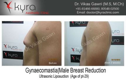 Gynaecomastia Male Breast reduction