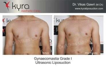 Gynaecomastia grade