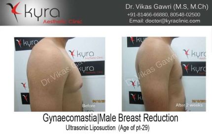 Gynaecomastia male Breast reduction