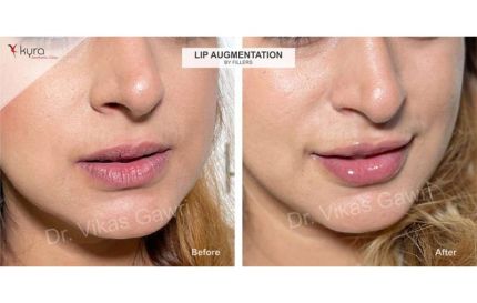 Lip Augmentation by Fillers