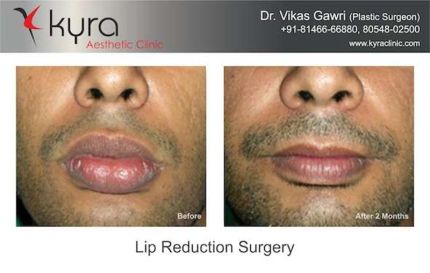 Lip Reduction Cosmetic Surgery Before and After Picture