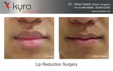 Lip Reduction Cosmetic Surgery in Ludhiana