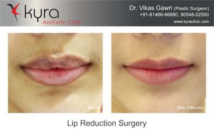 Lip Reduction Surgery Before and After Picture