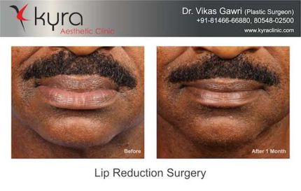 Lip Reduction Surgery for Men Before and After