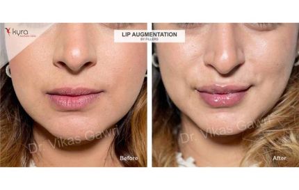 Lip Reduction Surgery for Women Before and After