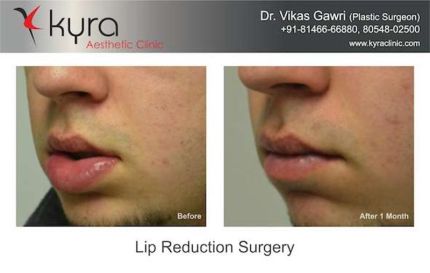 Lip Reduction Surgery in Ludhiana