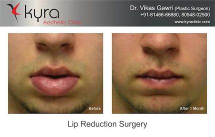 Lip Reduction Surgery in Vancouver