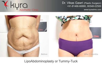 Lipo Abdomino Plasty or Tummy Tuck