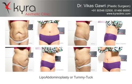 Lipo Abdomino Plasty or Tummy Tuck