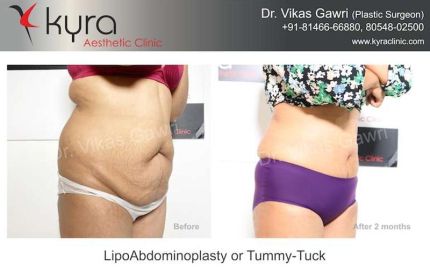 Lipo Abdomino Plasty or Tummy Tuck