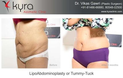 Lipo Abdomino Plasty or Tummy Tuck