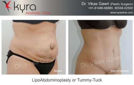 Lipo Abdomino Plasty or Tummy Tuck