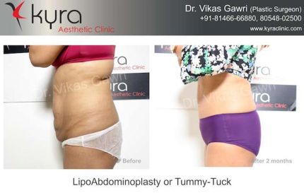 Lipo Abdomino Plasty or Tummy Tuck