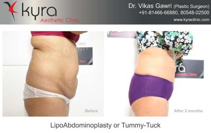 Lipo Abdomino Plasty or Tummy Tuck