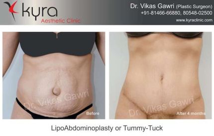 Lipo Abdomino Plasty or Tummy Tuck