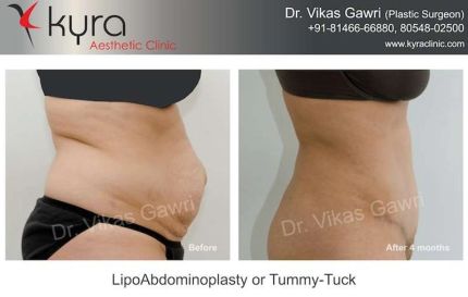 Lipo Abdomino Plasty or Tummy Tuck