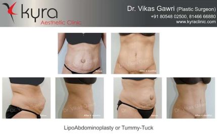 Lipo Abdomino Plasty or Tummy Tuck