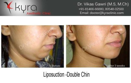 Liposuction Double Chin