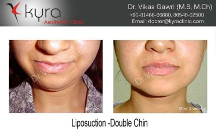 Liposuction Double Chin