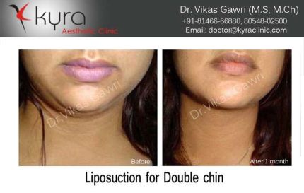 Liposuction For Double chin