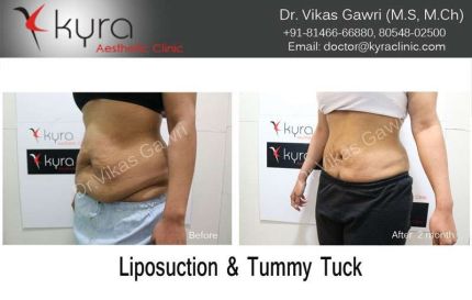 Liposuction Tummy Tuck