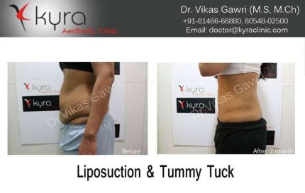 Liposuction Tummy Tuck