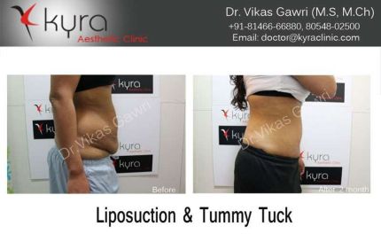 Liposuction Tummy Tuck